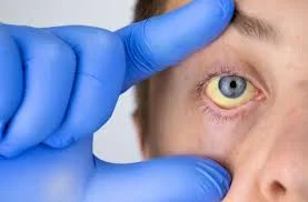 Anemia