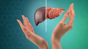 Fatty Liver